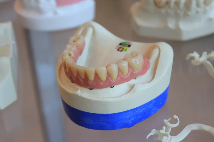 Denture set on a plaster cast on a dental laboratory bench